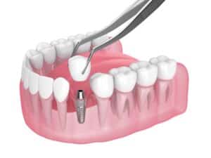 You have dental implant options in Simi Valley